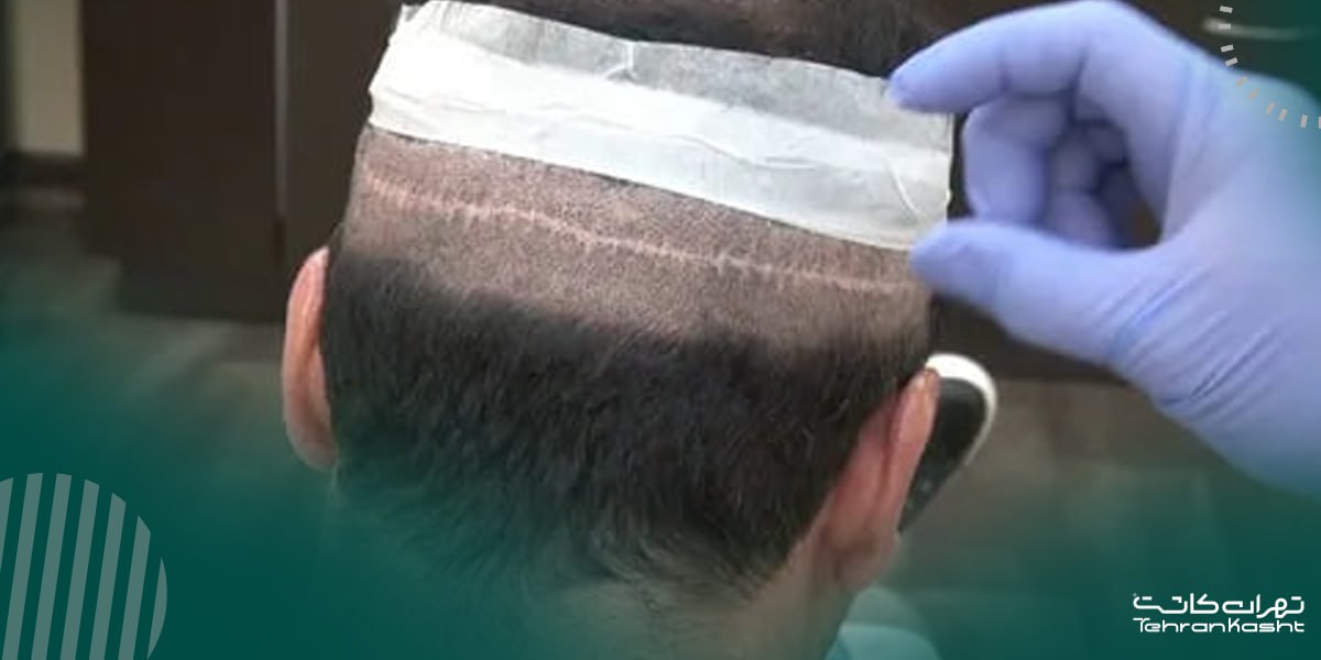 کاندید های کاشت مو به روش fut