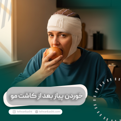خوردن پیاز بعد از کاشت مو