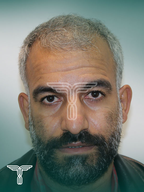 قبل کاشت مو