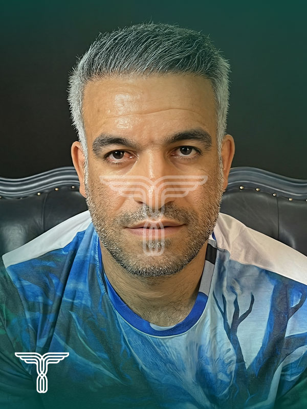 بعد کاشت مو