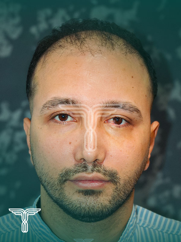 قبل کاشت مو