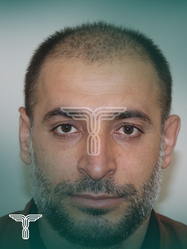 قبل کاشت مو