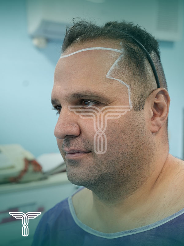 قبل کاشت مو