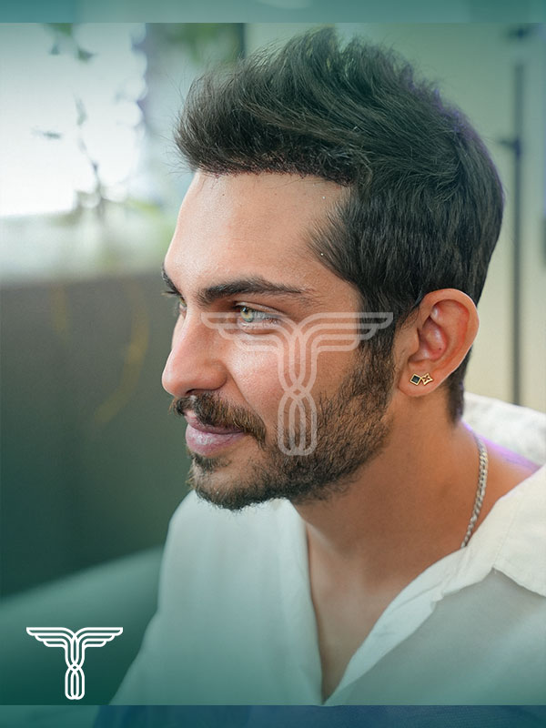 بعد کاشت مو