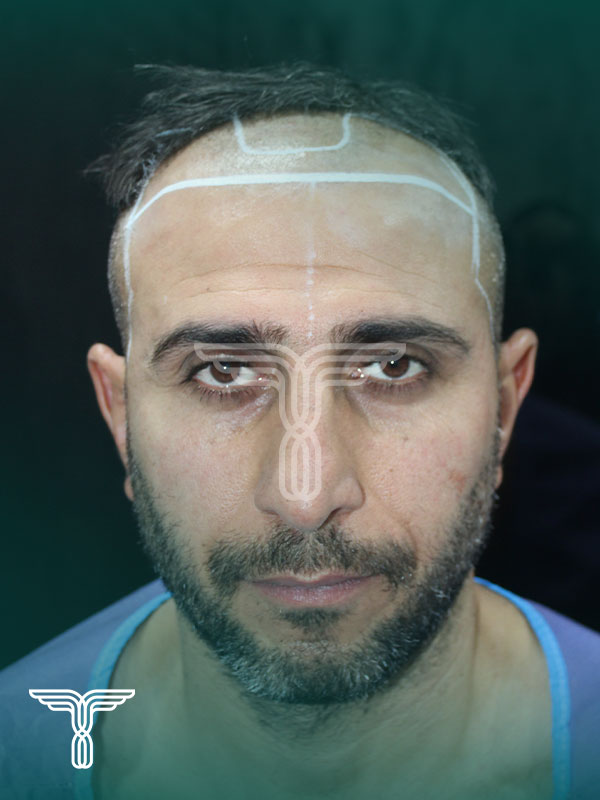 قبل کاشت مو