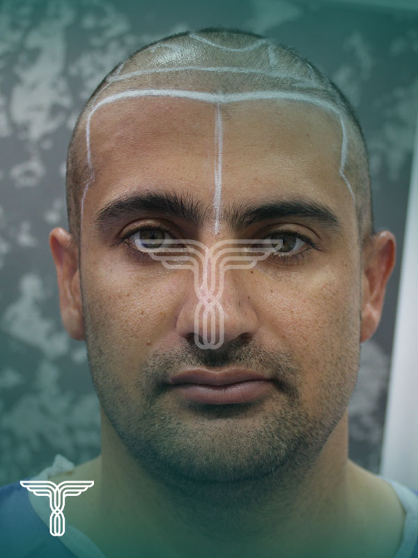 قبل کاشت مو