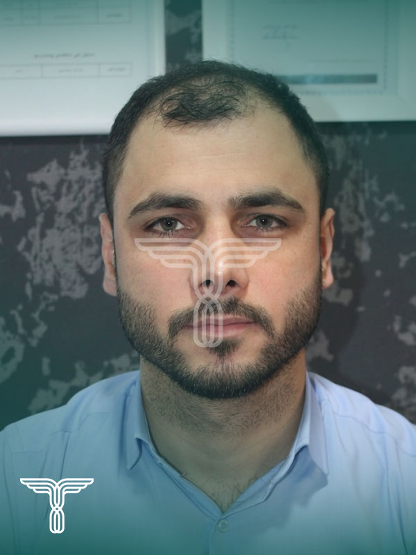 قبل کاشت مو