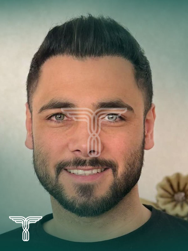 بعد کاشت مو