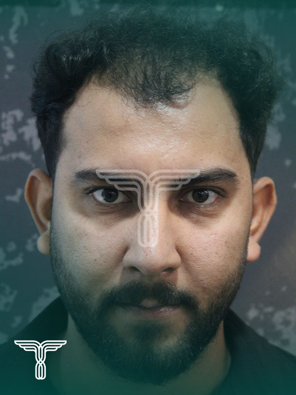 قبل کاشت مو