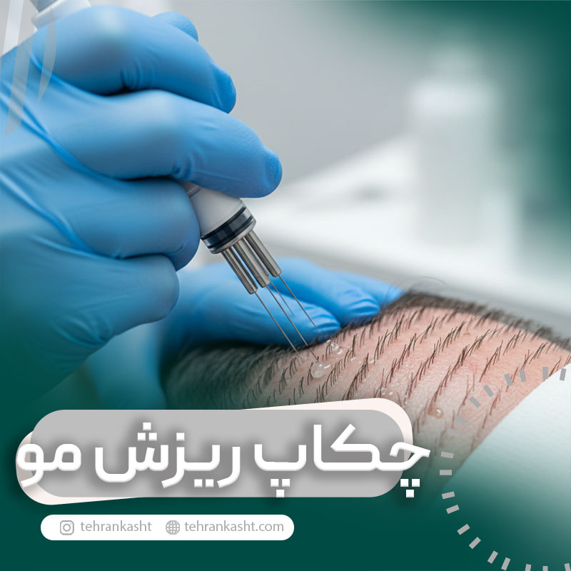 تاثیر مزوتراپی بر موهای کاشته شده