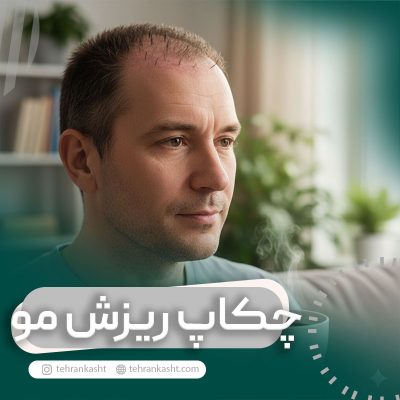 خوردن قهوه بعد از کاشت مو