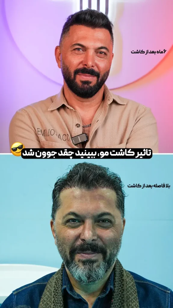 نمونه کار کاشت مو بدون کوتاهی و تراشیدن مو به روش آی تی پلاس پلاس در کلینیک تهران کاشت