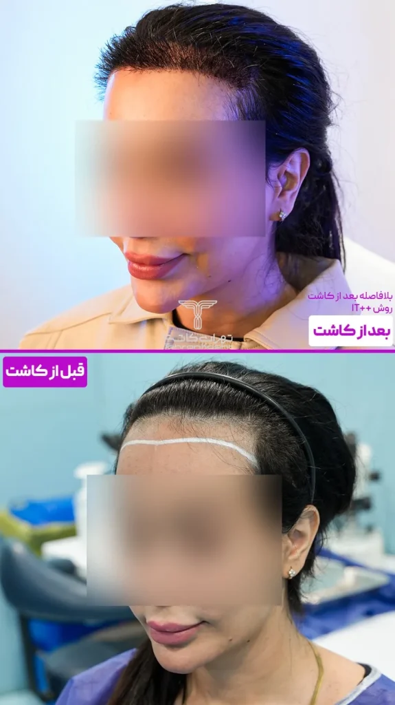نمونه کار کاشت مو بدون کوتاهی و تراشیدن مو به روش آی تی پلاس پلاس در کلینیک تهران کاشت