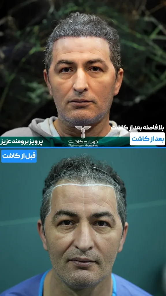 نمونه کار کاشت مو بدون کوتاهی و تراشیدن مو به روش آی تی پلاس پلاس در کلینیک تهران کاشت