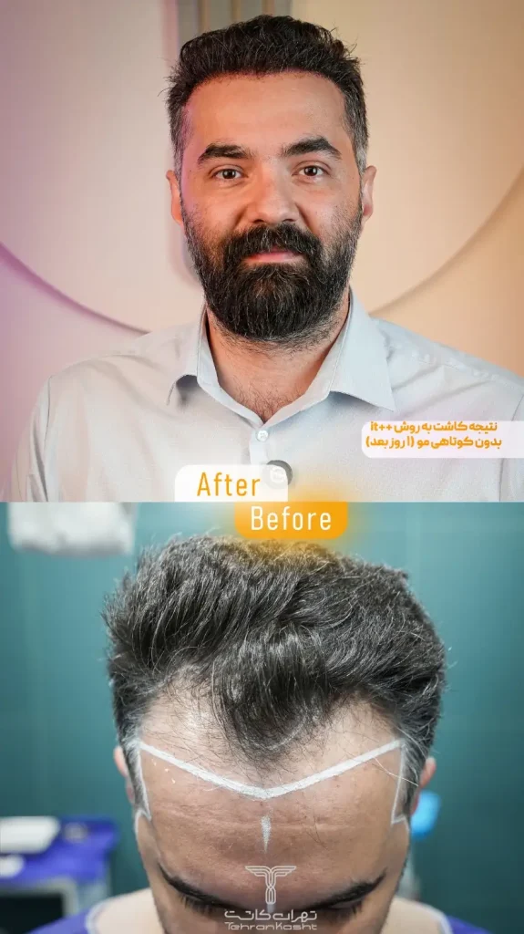 نمونه کار کاشت مو بدون کوتاهی و تراشیدن مو به روش آی تی پلاس پلاس در کلینیک تهران کاشت