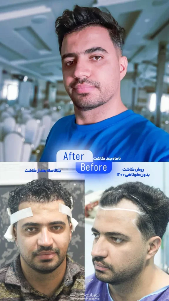 نمونه کار کاشت مو بدون کوتاهی و تراشیدن مو به روش آی تی پلاس پلاس در کلینیک تهران کاشت