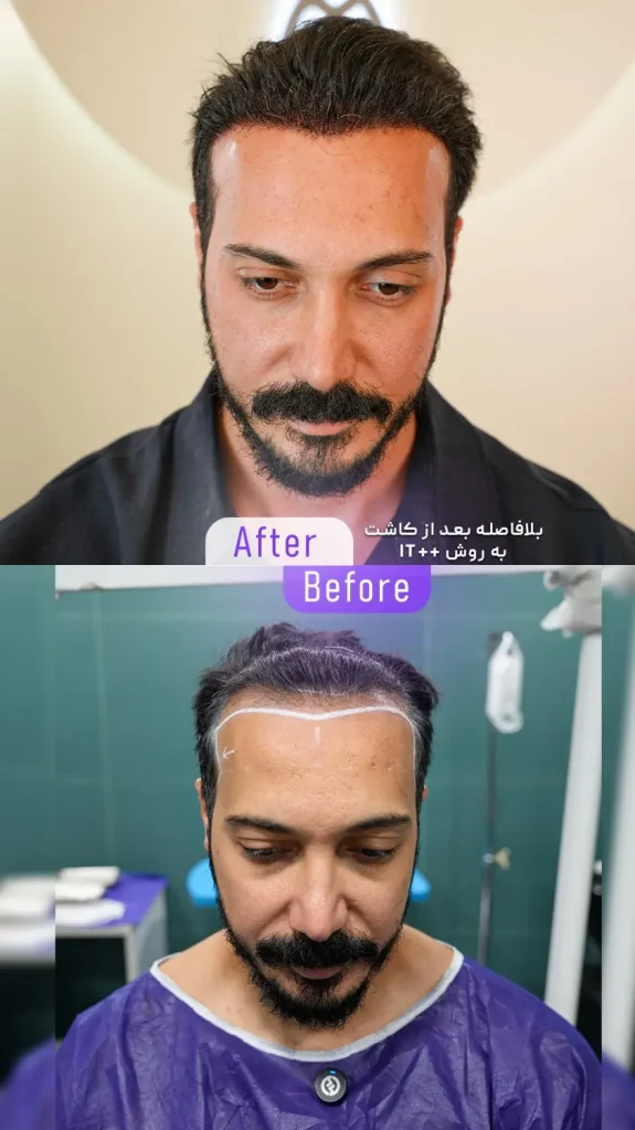 نمونه کار کاشت مو بدون کوتاهی و تراشیدن مو به روش آی تی پلاس پلاس در کلینیک تهران کاشت