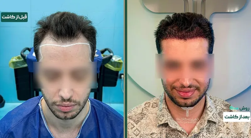 کاشت مو بدون تراشیدن سر روش it++